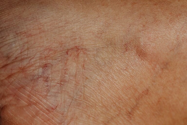 Bed bug attack leaves woman covered in bites after Travelodge stay